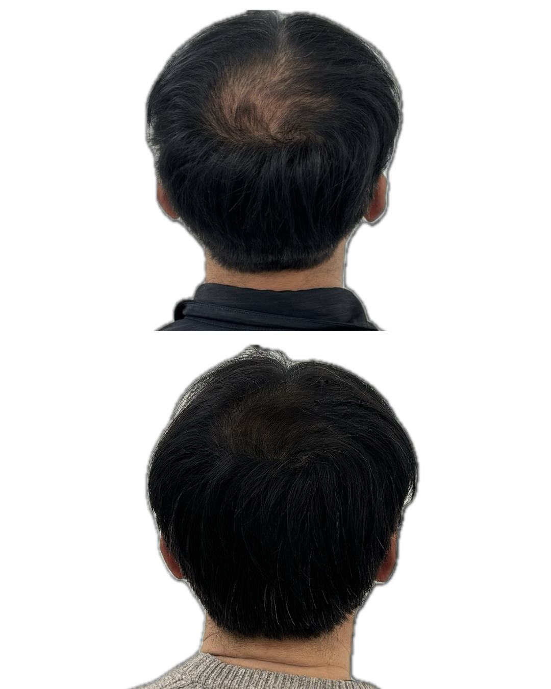 비포애프터 1 — 남성 뒷통수